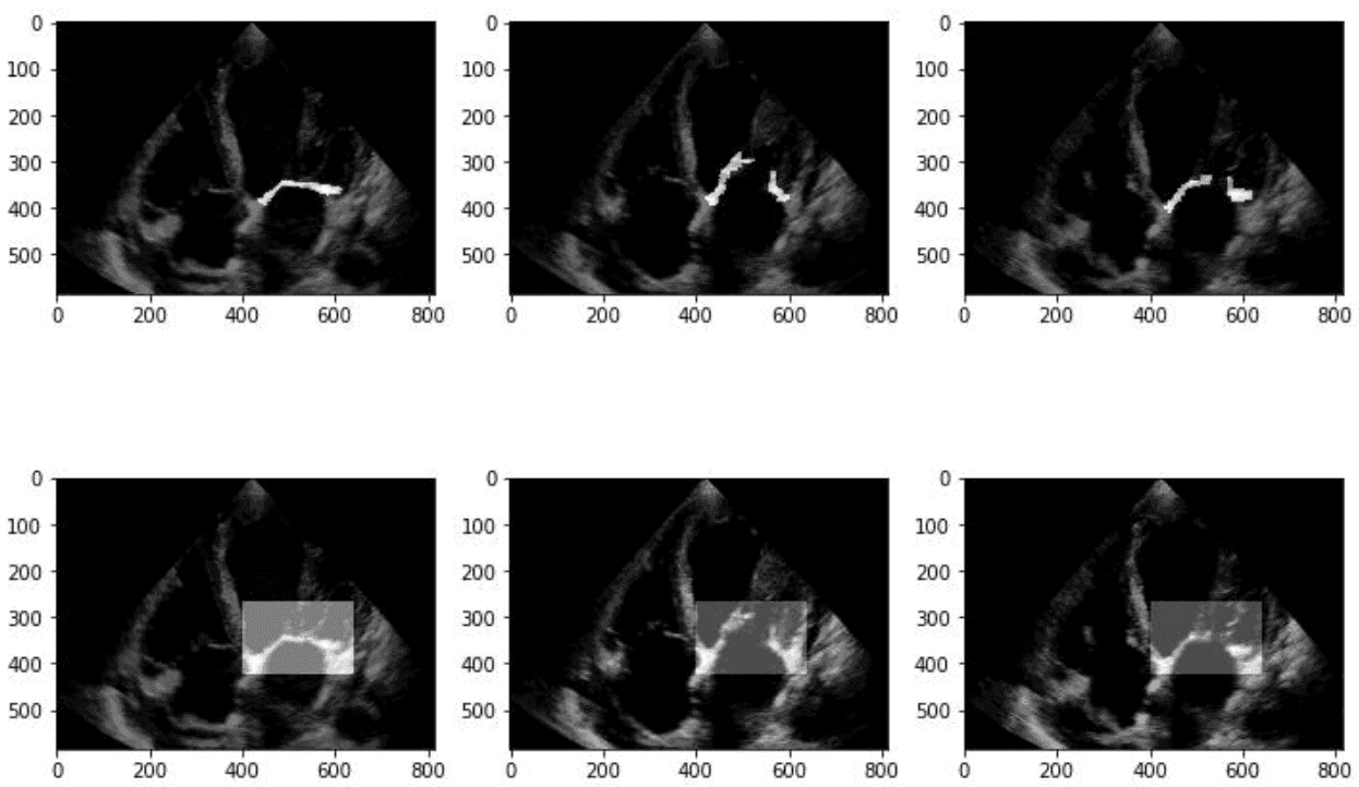 Mitral Valve Segmentation